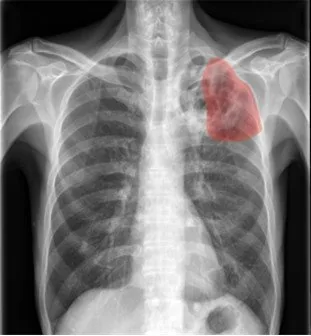 Chest X-ray showing a highlighted lung abnormality
